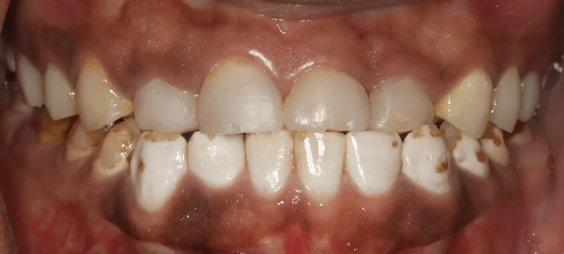 Full mouth reconstruction before treatment
