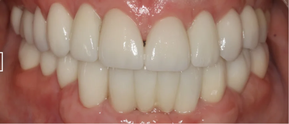 Smile rehabilitation after treatment